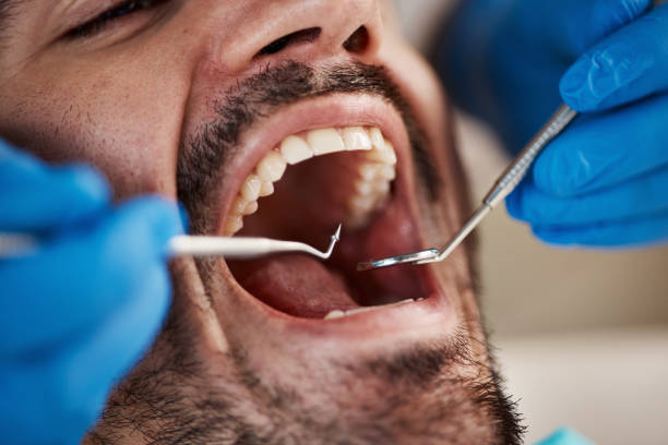 Best Emergency Treatment for Dental Infections or Abscesses in Kingston, NY