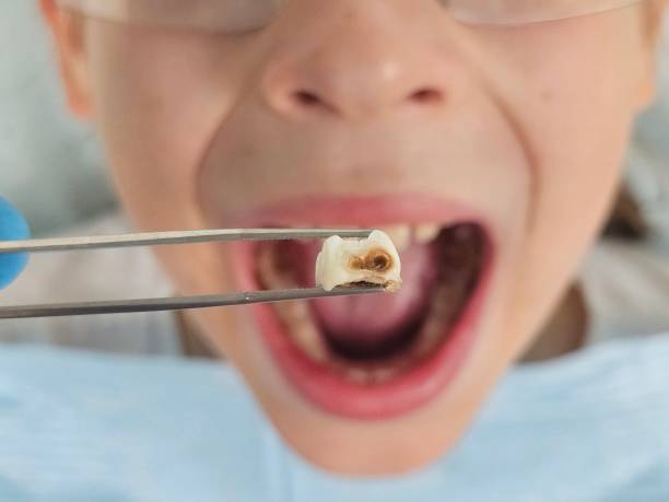 Best Emergency Root Canal Treatment in Kingston, NY